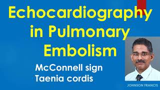 Echocardiography in Pulmonary Embolism [upl. by Dubenko]