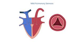 Pulmonary Stenosis [upl. by Eustache]