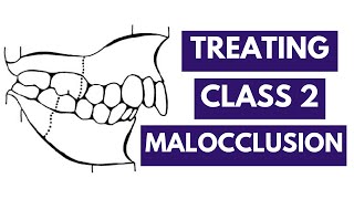 Management of Class 2 Malocclusion Orthodontics [upl. by Jsandye]