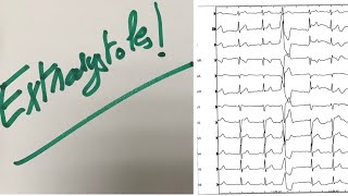 Extrasystoles ablation pour tous [upl. by Ettezel347]