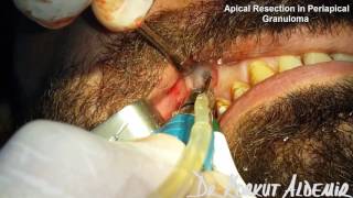 Apical Resection in Periapical Granuloma [upl. by Zoltai]