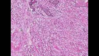 Histopathology BreastLobular carcinoma [upl. by Jewelle]